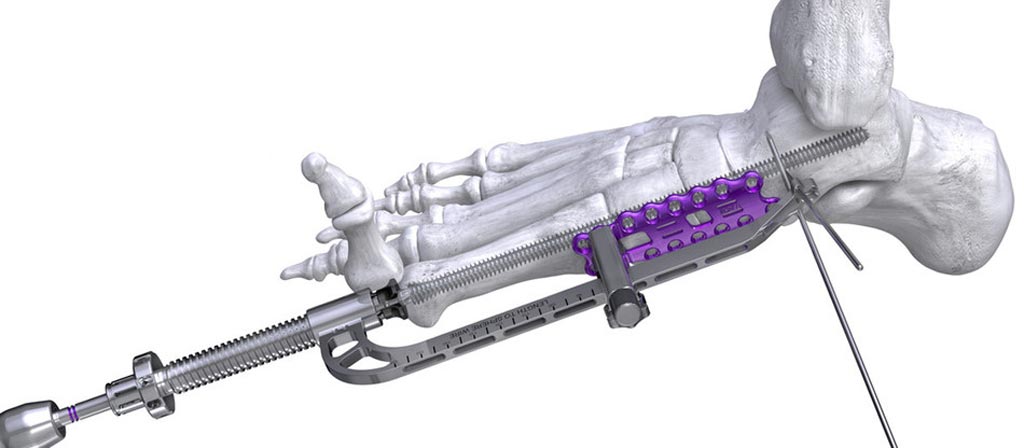 Image: The Joust Beaming Screw System and PRECISION Reduction Guide (Photo courtesy of Paragon 28).