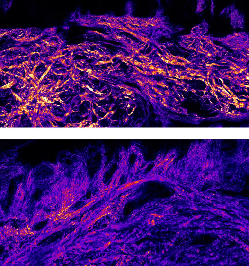 Image: Collagen bundles fibers are much thicker in plantar skin (T) than body skin (B) (Photo courtesy of Imperial).