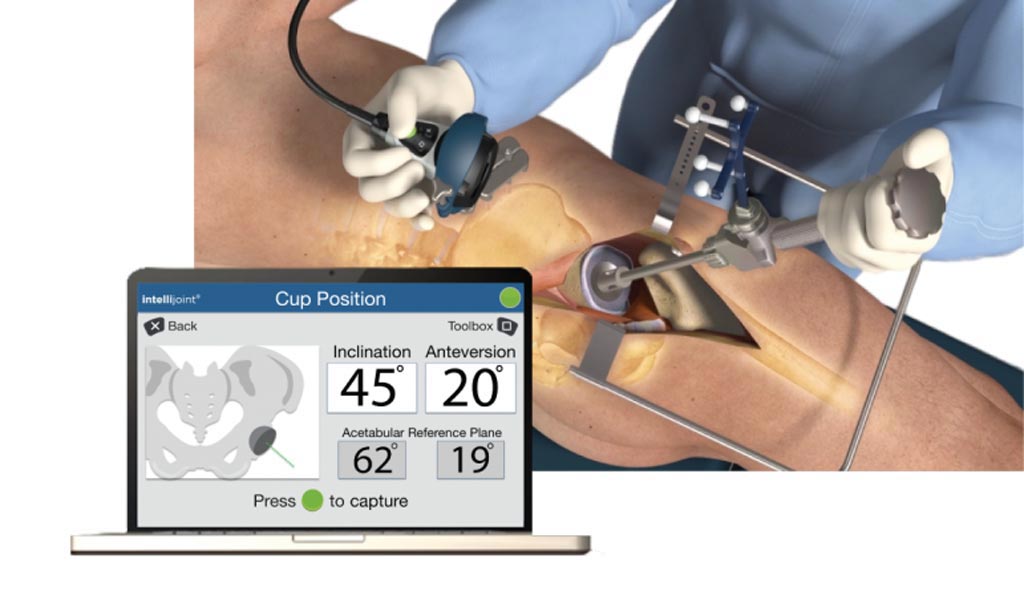 Image: An innovative mini-optical system helps ensure accurate THA (Photo courtesy of Intellijoint Surgical).