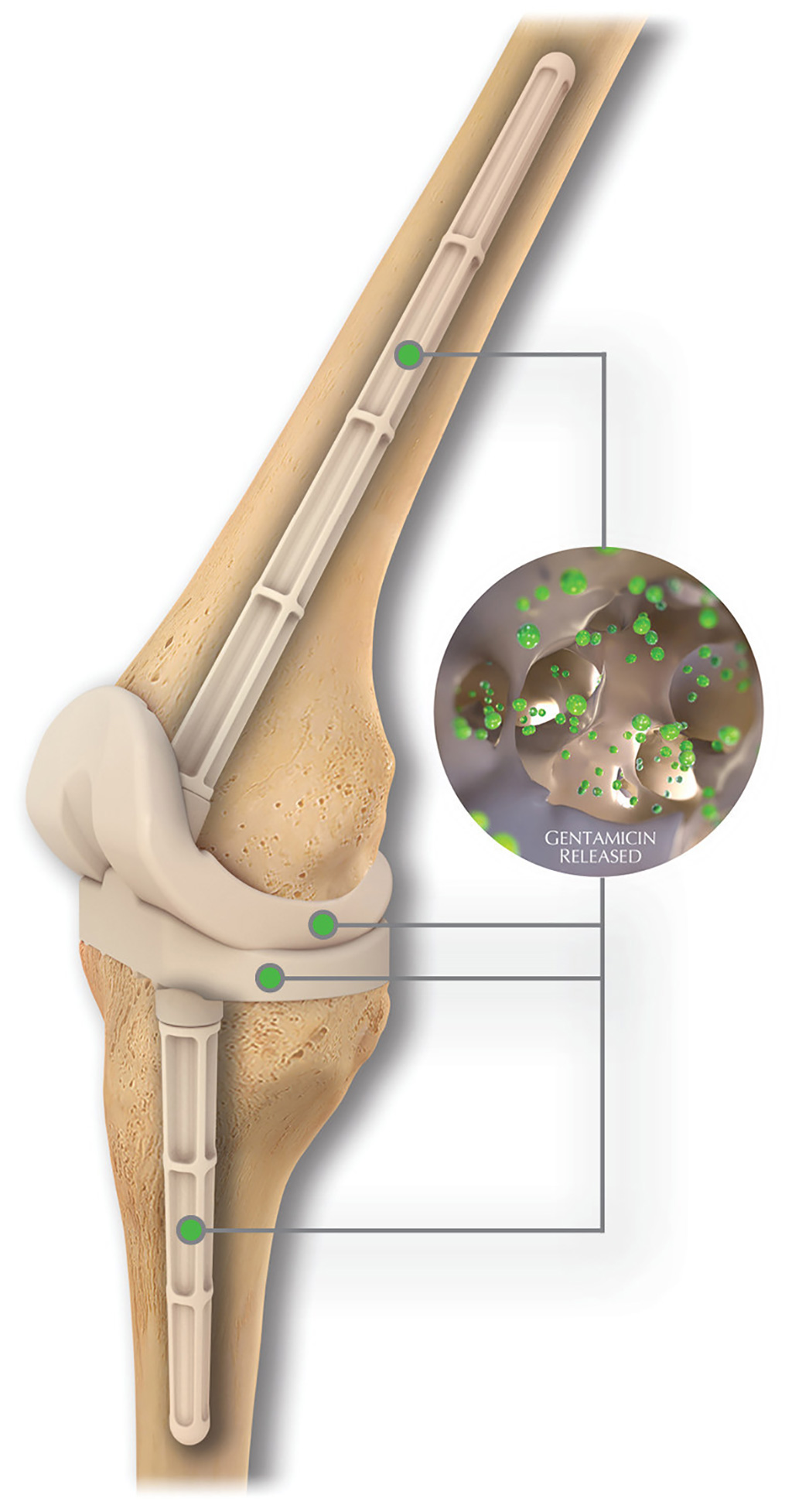 Image: The REMEDY Stemmed Knee Spacer (Photo courtesy of OsteoRemedies)
