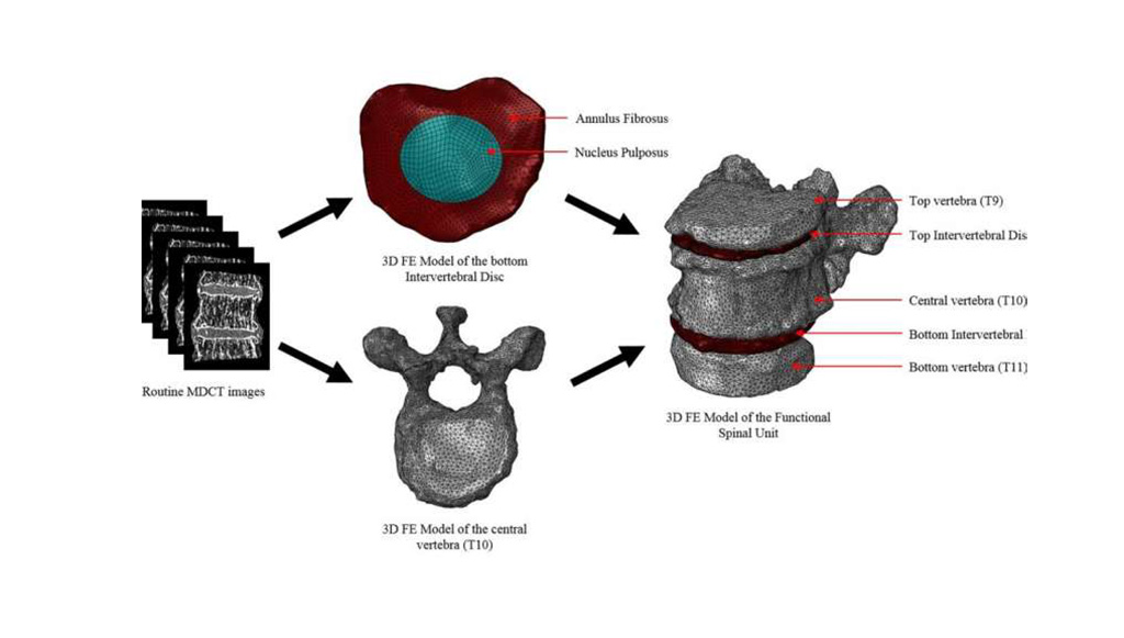 Image:  Finite analysis can help determine cervical bone strength (Photo courtesy of SUTD)