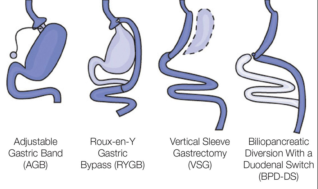 Image: The four common types of bariatric surgery (Photo courtesy of NIH)