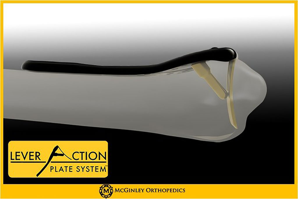 Image: The Lever Action Plate System (Photo courtesy of McGinley Orthopedics)