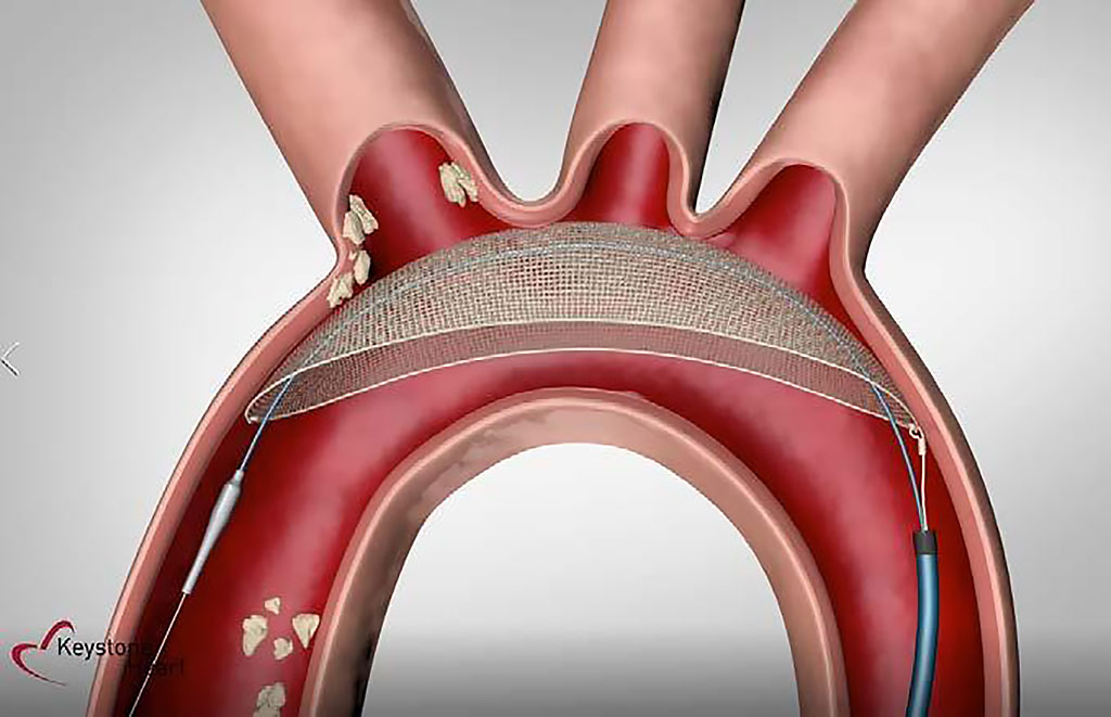 Image: The TriGuard 3 CEP device protects all three aortic arch branches (Photo courtesy of Keystone Heart)