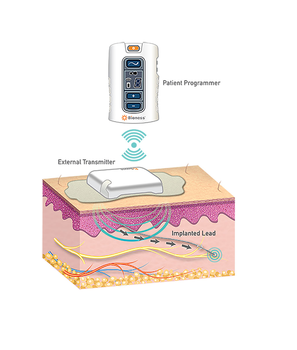 Image: The StimRouter neuromodulation system (Photo courtesy of Bioness)