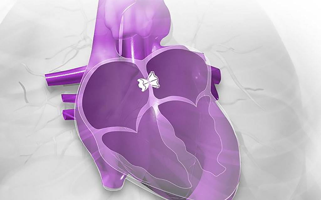 Image: The Ventura interatrial shunt system implant (Photo courtesy of V-Wave)