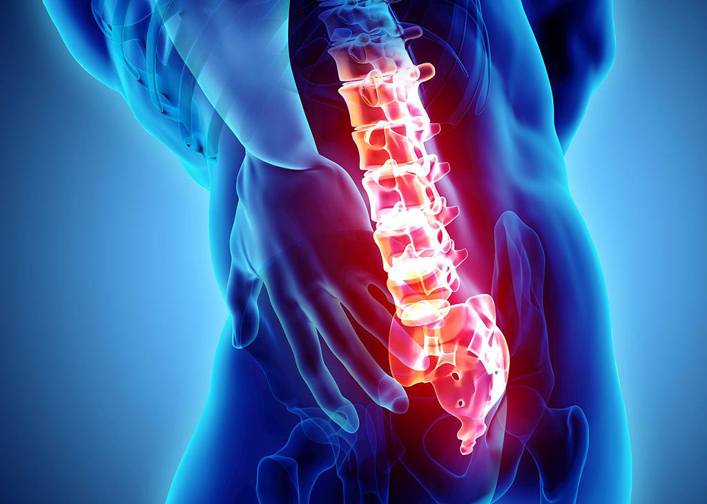 Image: Lumbar microdiskectomy is the best solution for chronic Sciatica pain (Photo courtesy of 123RF)