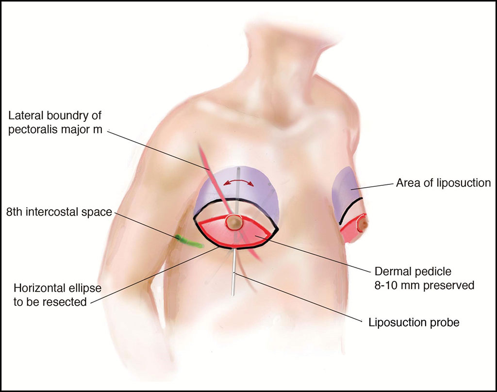 Image: Illustration of preoperative markings and pertinent reference points (Courtesy of UT Soutwestern)