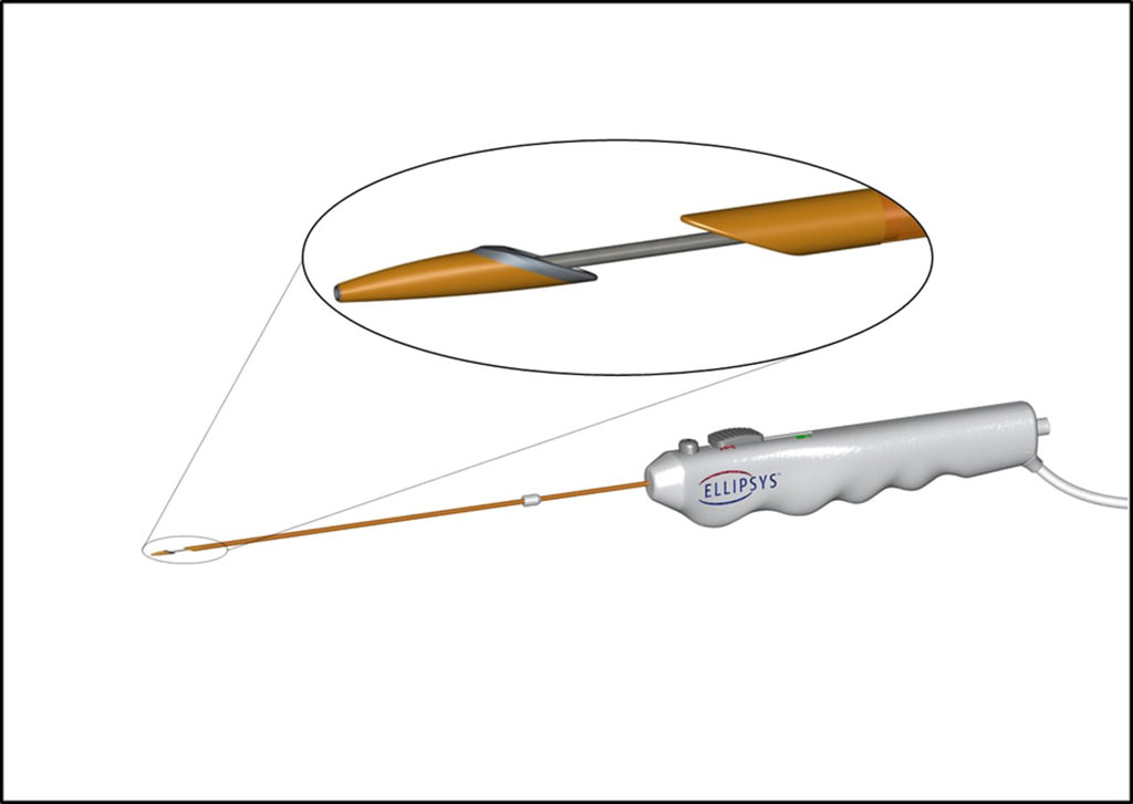 Image: The Ellipsys Vascular Access System (Photo courtesy of Avenu Medical)