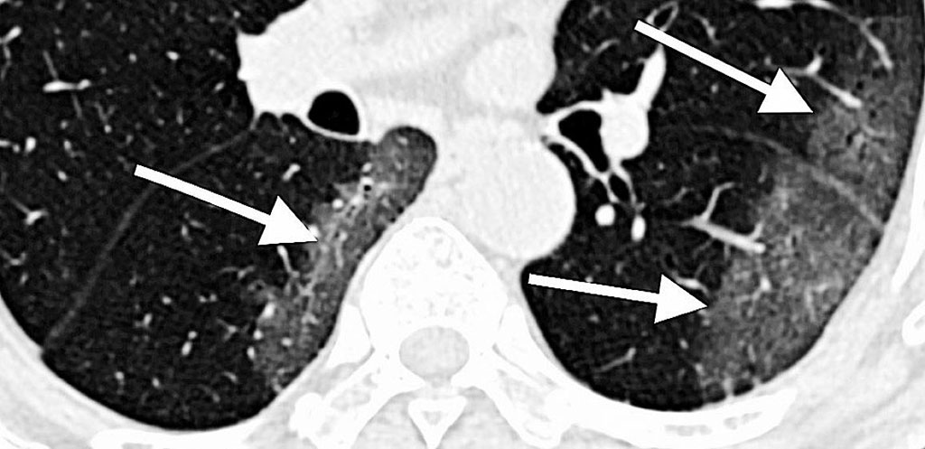 Image: CT scan of lungs of COVID-19 patient with areas described by radiologists as resembling grains of ground glass. (Photo courtesy of RSNA)