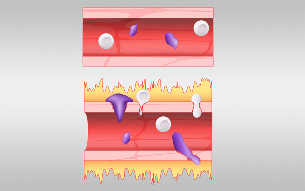 Image: A normal blood vessel, shown at top, is compared with a blood vessel affected by excess bradykinin (Photo courtesy of Oak Ridge National Laboratory)