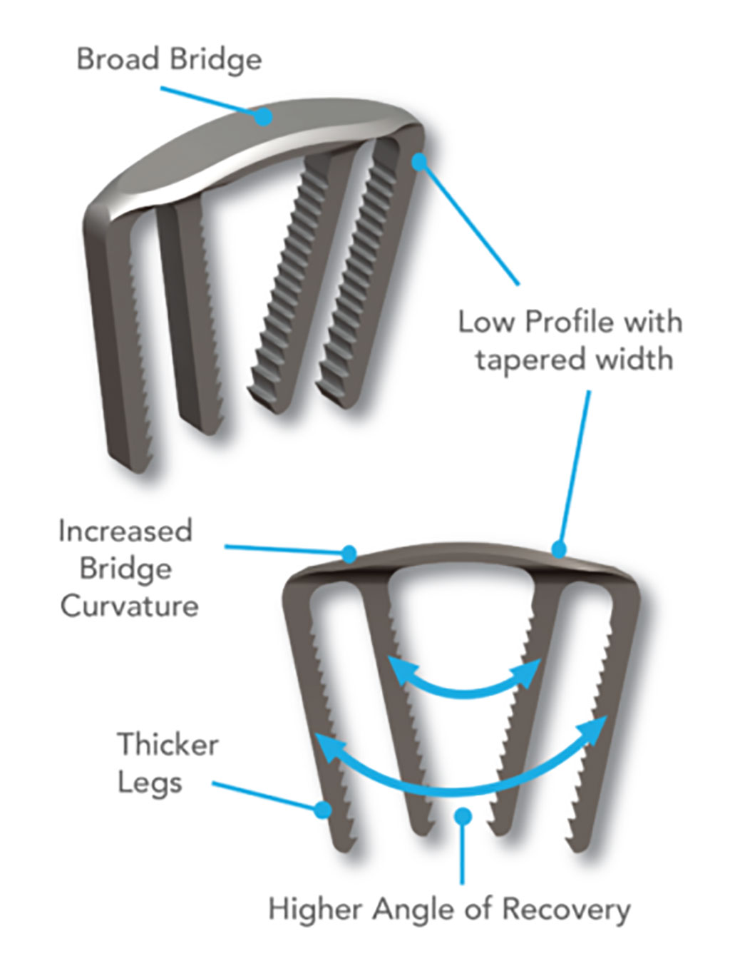 Image: The DynaClip Forte Bone Fixation System (Photo courtesy of Medshape)