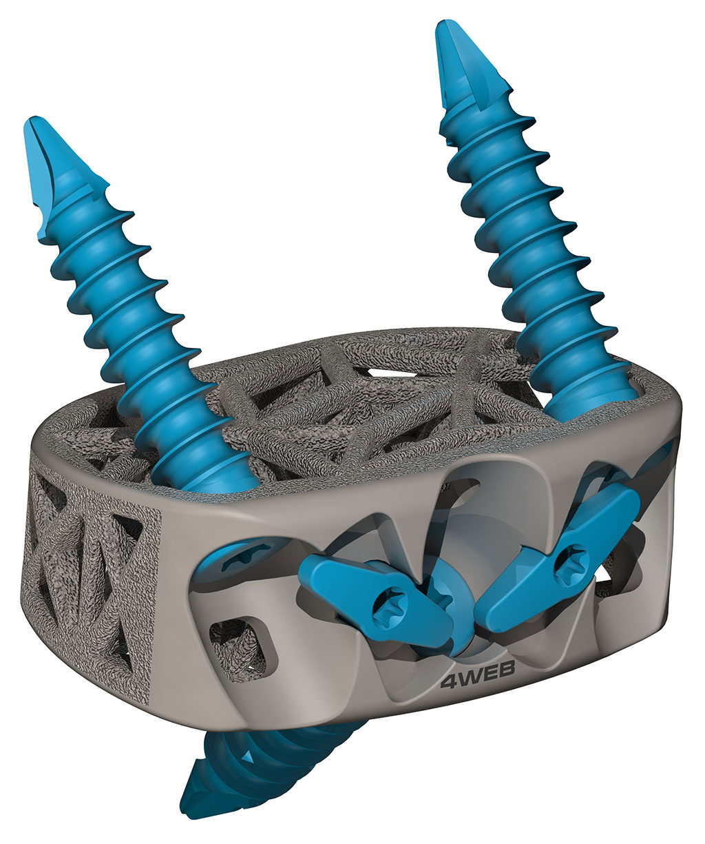 Image: The Stand-Alone Anterior Spine Truss System (ASTS-SA) (Photo courtesy of 4WEB Medical)