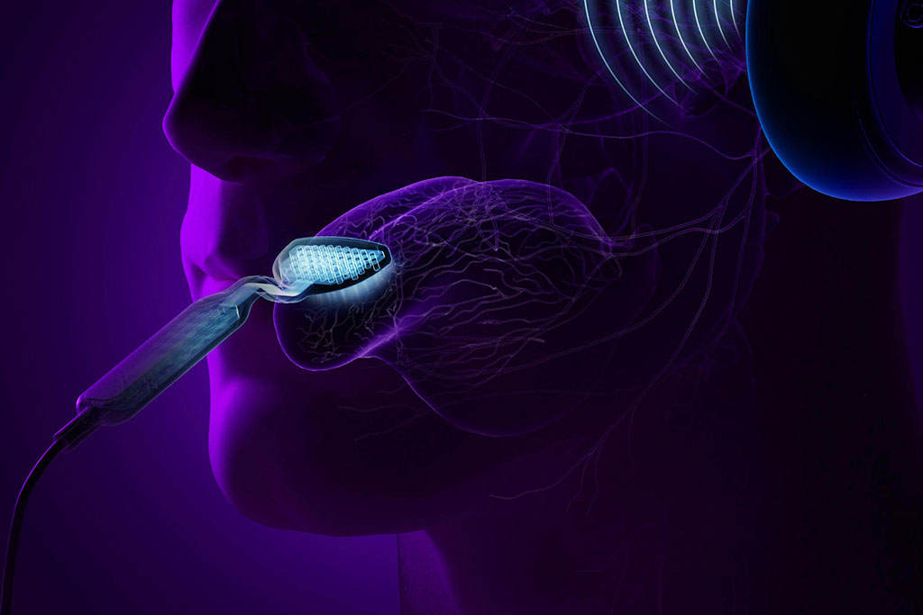 Image: Simultaneously stimulating the tongue and auditory system can treat tinnitus (Photo courtesy of Neuromod Devices)