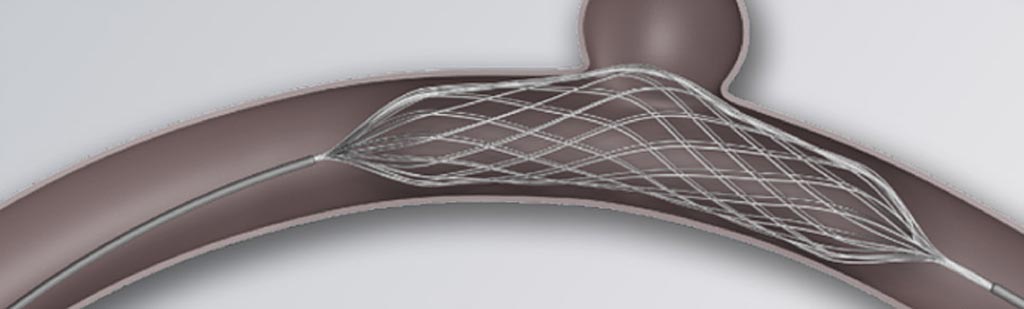Image: The Comaneci adjustable remodeling mesh stent (Photo courtesy of Rapid Medical)