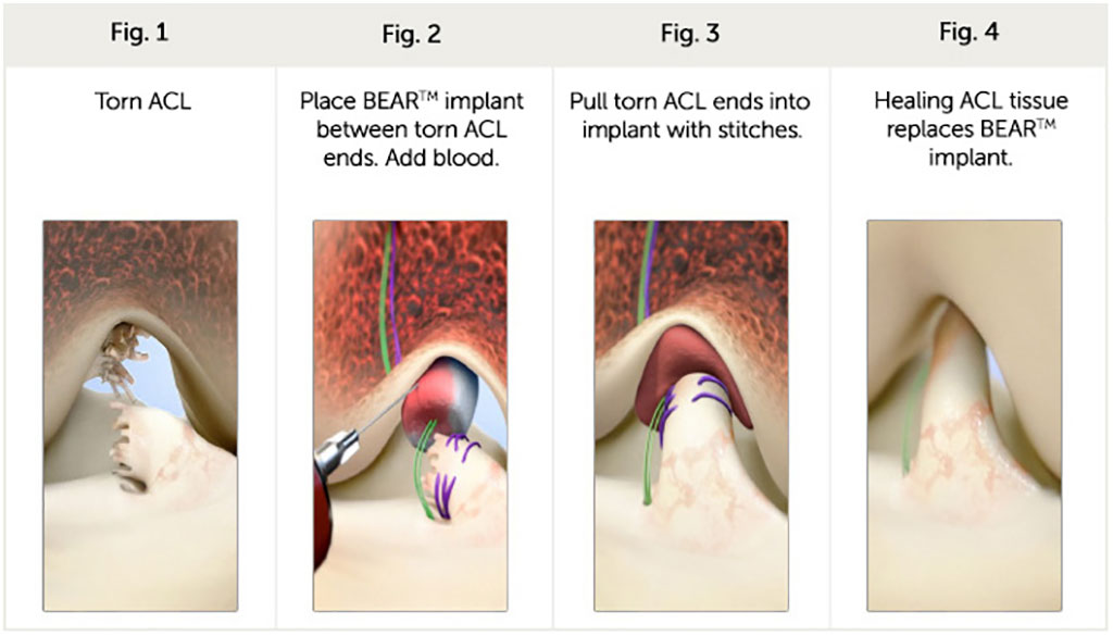 Image: An ECM implant repairs a torn ACL (Photo courtesy of Miach Orthopaedics)