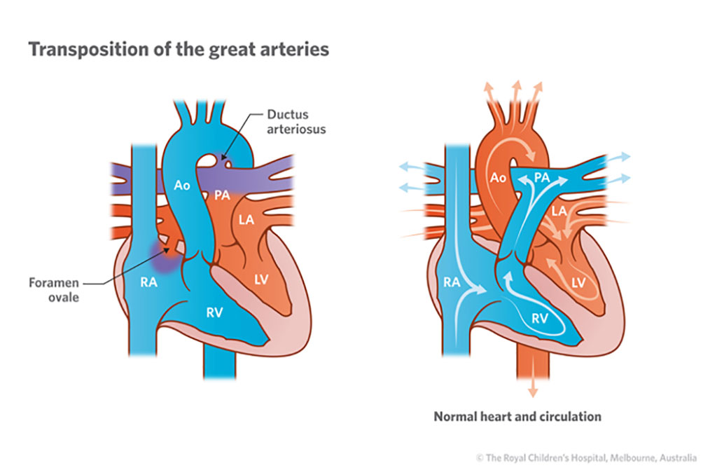 Image: In TGA, the aorta and pulmonary are reversed (Photo courtesy of Royal Children’s Hospital)