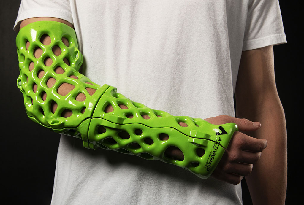 Image: Exoskeleton Orthopedic Casts Form-Fit Human Anatomy (Photo courtesy of ActivArmor)