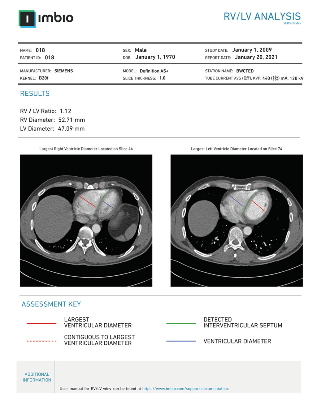 Image: A sample RV/LV Analysis report (Photo courtesy of Imbio)