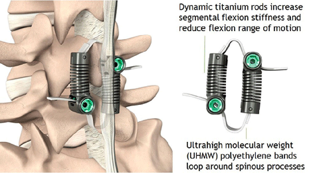 Image: Strapping spinal processes together can stabilize flexion (Photo courtesy of Empirical Spine)