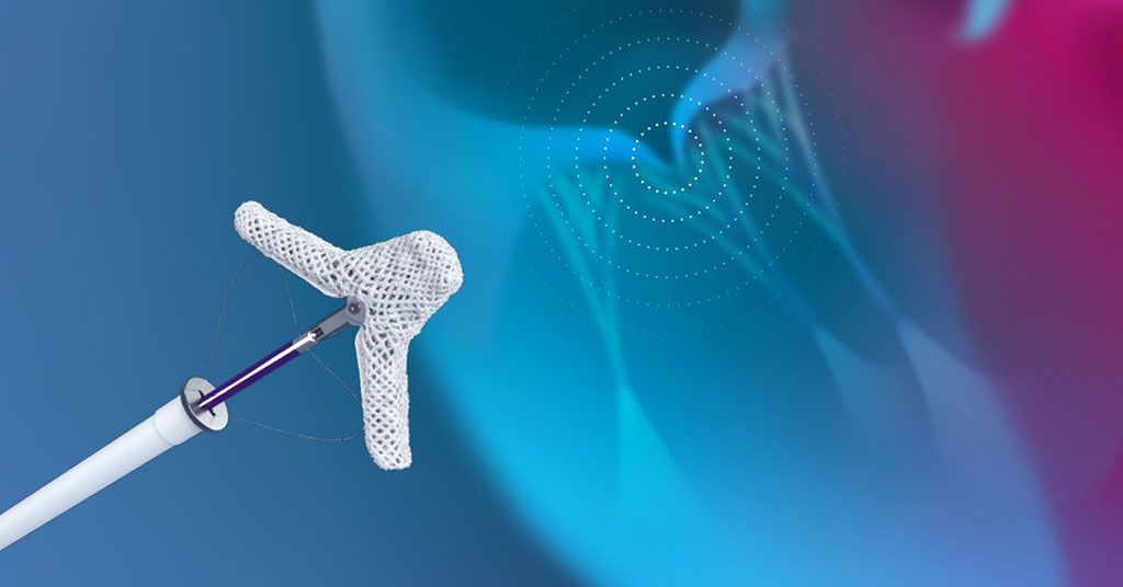 Image: The Abbott TriClip G4 for tricuspid regurgitation repair (Photo courtesy of Abbott)