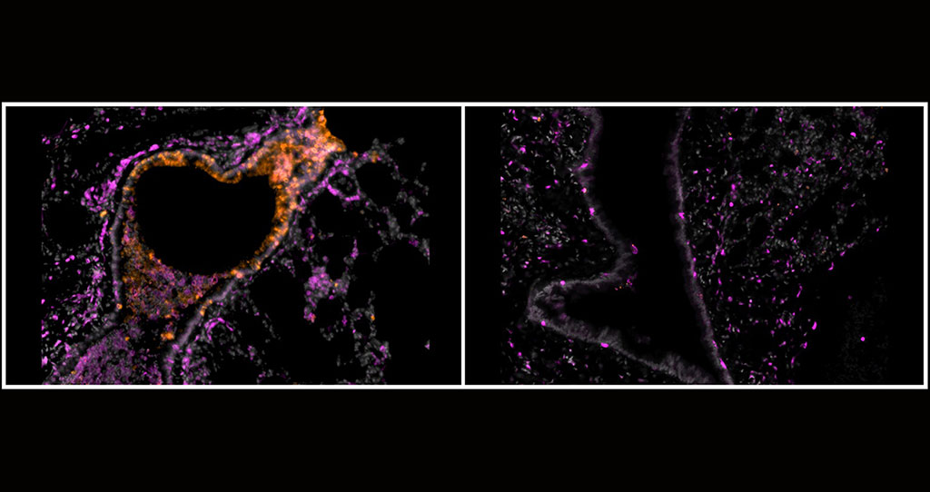 Image: A new study published in Science Advances found that inhalable nanobodies targeting the spike protein of the SARS-CoV-2 coronavirus can prevent and treat severe COVID-19 in hamsters. Here, bronchioles of hamsters sick with COVID-19 untreated (left) and treated with inhalable nanobodies (right) show the impact of the approach (Photo courtesy of Nambulli et al., Science Advances)
