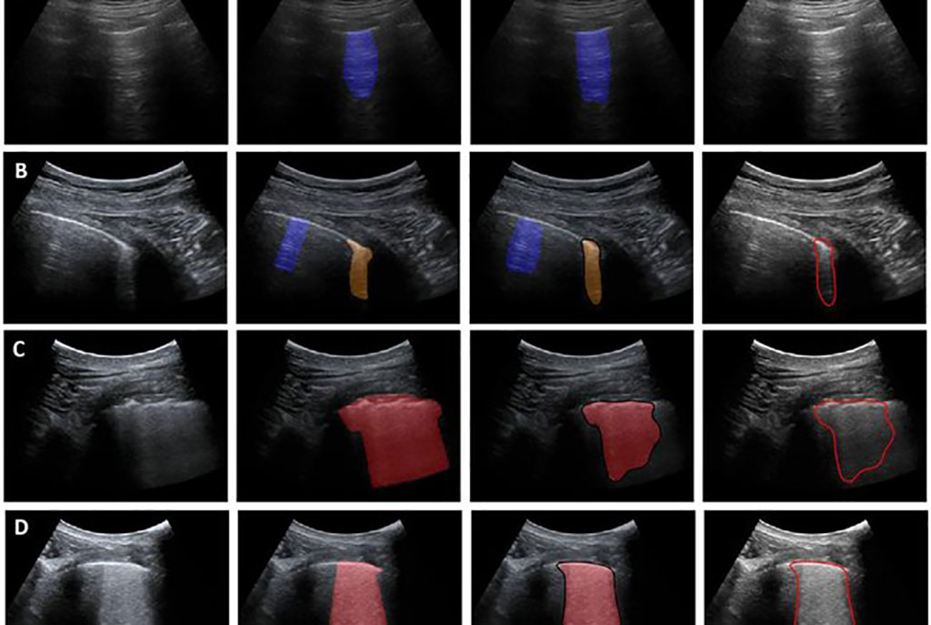Image: Column 1 and 2 show lung ultrasounds without and with annotated COVID-19 biomarkers (orange: moderate, red: severe). Columns 3 and 4 respectively show the semantic segmentations and contours of COVID-19 markers by means of deep learning analysis (Photo courtesy of Eindhoven University of Technology)