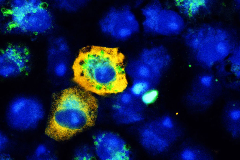 Image: When SARS-CoV-2 (yellow) infects monkey kidney cells, it reduces the cellular recycling mechanism, meaning there are fewer autophagy signals (green) than in non-infected cells. Blue staining depicts nuclei (Photo courtesy of University Hospital Bonn/Daniel Heinz)