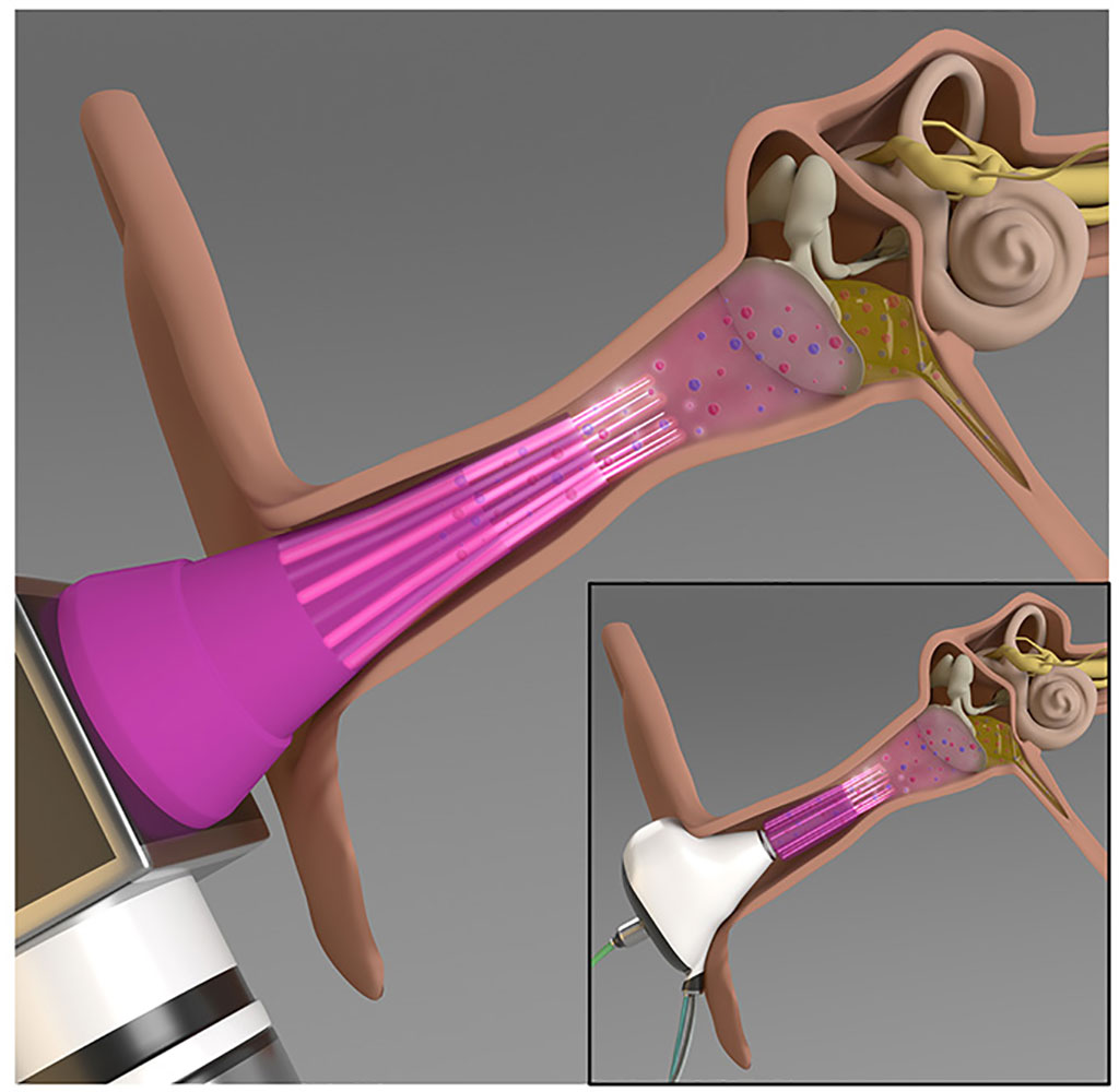 Image: The cold plasma-integrated otoscope and earbud for the treatment of otitis media (Photo courtesy of UIL)