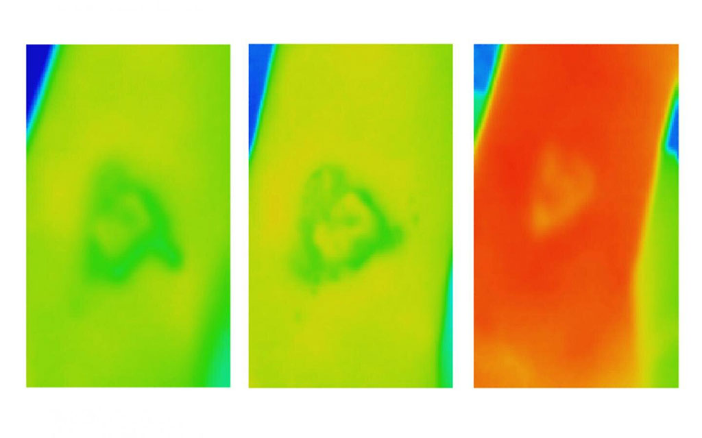 Image: Thermal images of a venous leg ulcer that ultimately failed to heal (Photo courtesy of RMIT)