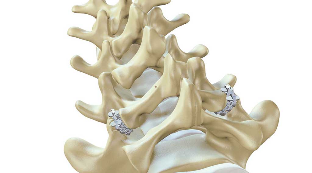 Image: The zLOCK Spinal Fusion System (Photo courtesy of ZygoFix)