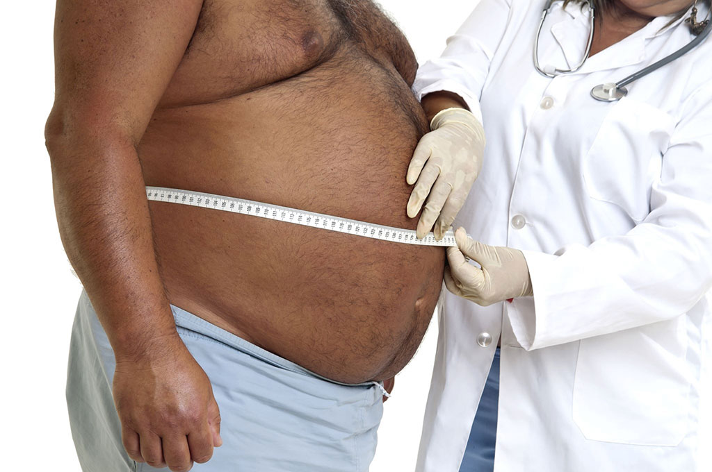 Image: Obesity offers a protective role in surgery patients (Photo courtesy of Megapixel)