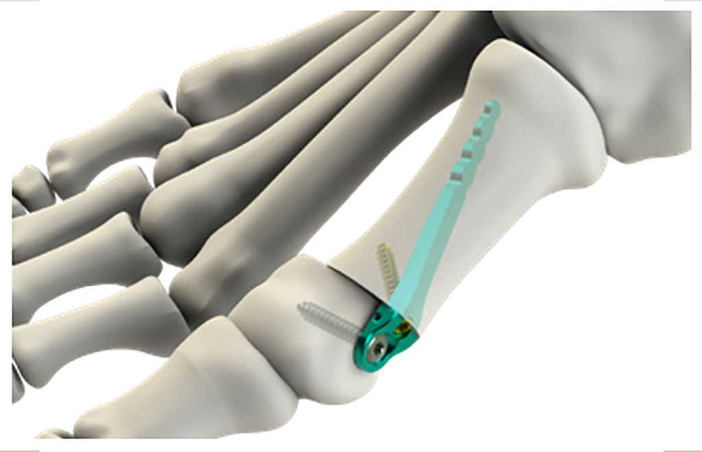 Image: The miniBunion micro-titanium implant straightens the big toe (Photo courtesy of CrossRoads Extremity Systems)