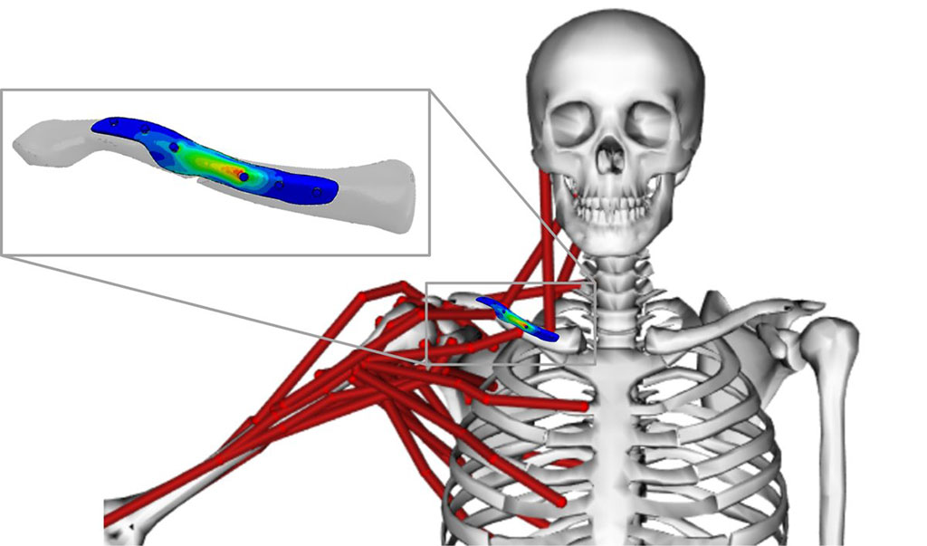 Image: Custom clavicle plate developed through modeling (Photo courtesy of Sanne Van Cleef/ KU Leuven)