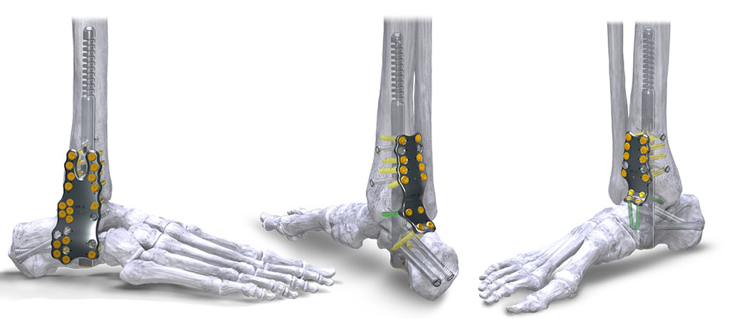 Image: The Silverback Straddle Plating System (Photo courtesy of Paragon 28)