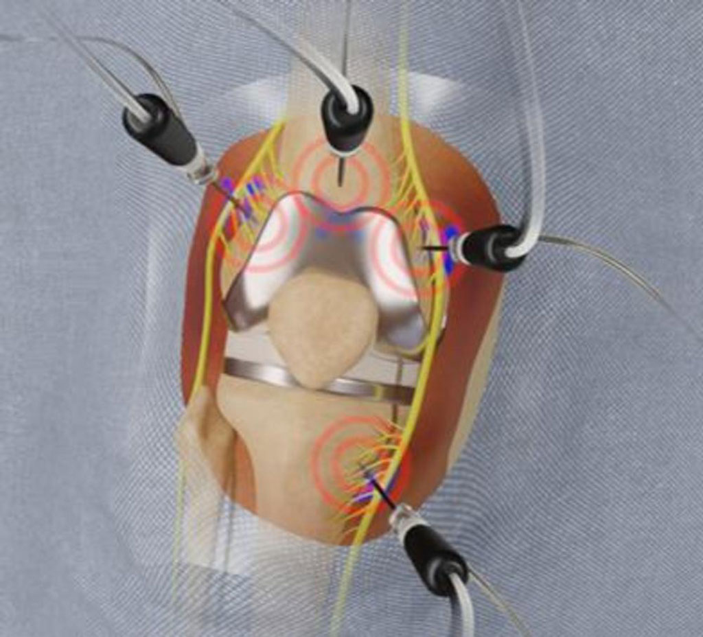 Image: The cooled radiofrequency ablation (C-RFA) procedure (Photo courtesy of Dr. Felix Gonzalez/ RSNA)