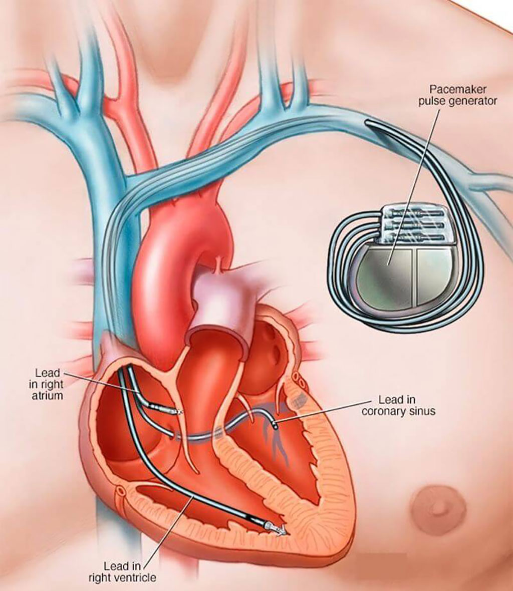 Image: Placement of a transvenous ICD (Photo courtesy of Mayo Clinic)