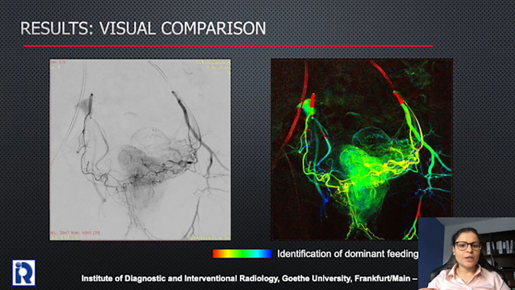 Image: A visual comparison of DSA (L) and DVA (R) (Photo courtesy of RSNA)