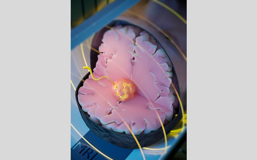 Image: Minimally Invasive Image-Guided Ablation (Photo courtesy of University College London)