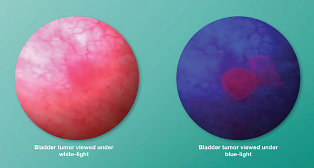 Image: Blue Light Cystoscopy with Cysview images (Photo courtesy of KARL STORZ)