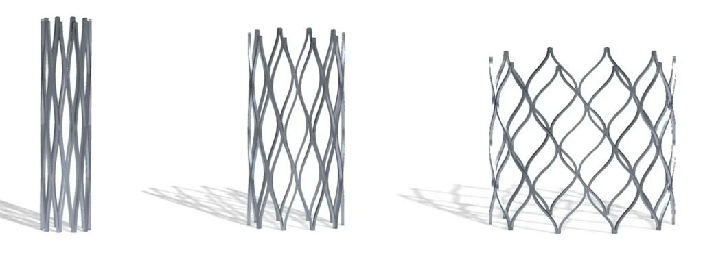 Image: Renata Minima Stent can be gradually expanded up to adult size over the course of the child’s lifetime (Photo courtesy of Renata Medical)