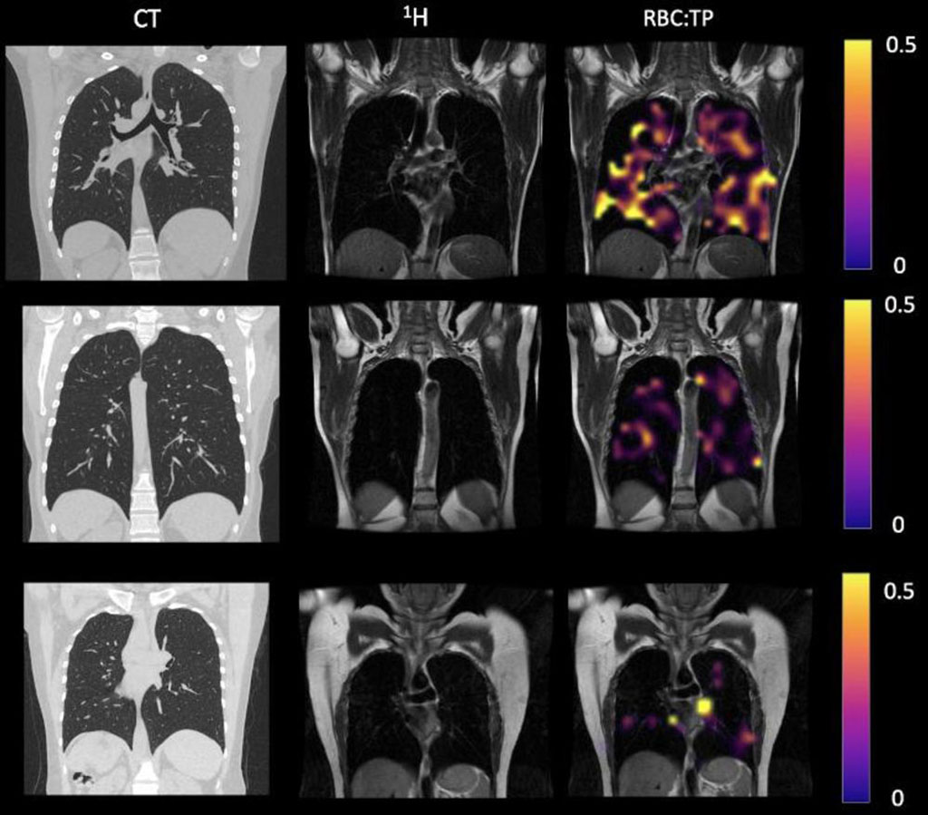 Image: Example CT, proton, proton and RBC:TP imaging from post-COVID-19 condition study participants (Photo courtesy of University of Sheffield)