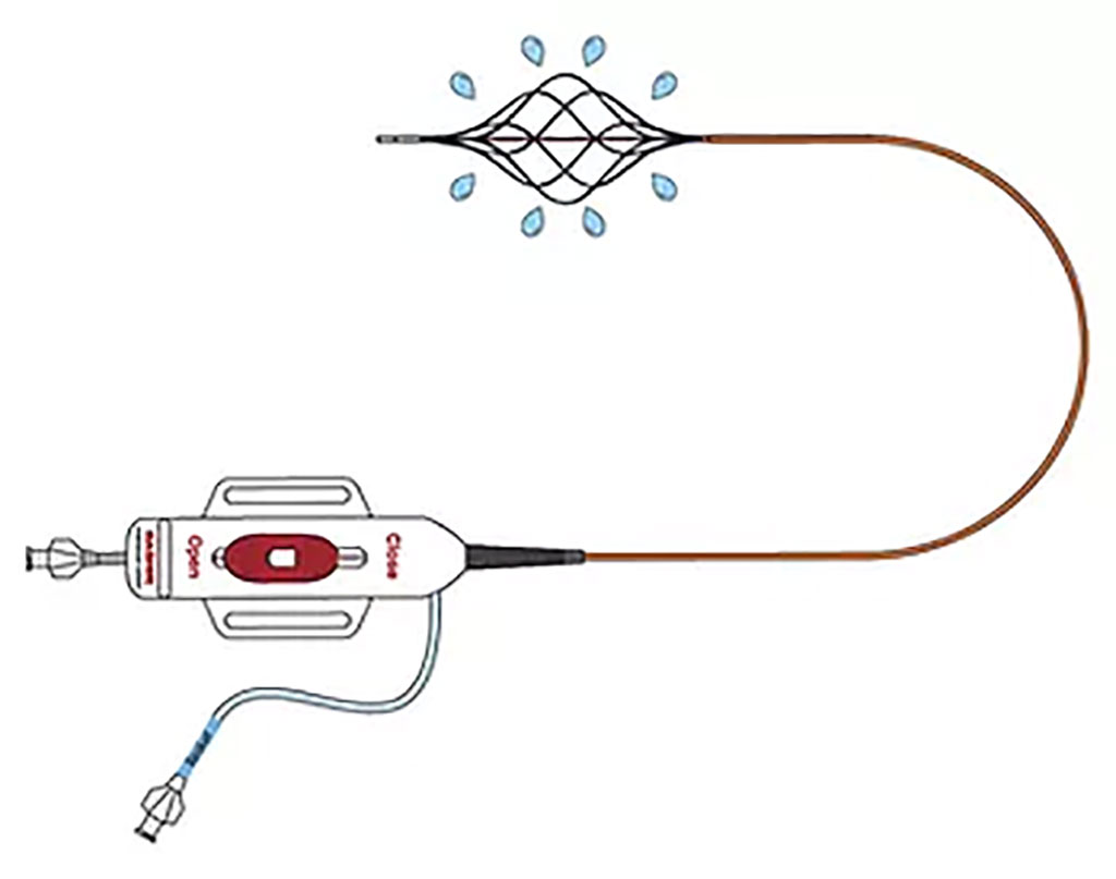 Image: The BASHIR Endovascular Catheter (Photo courtesy of THROMBOLEX)