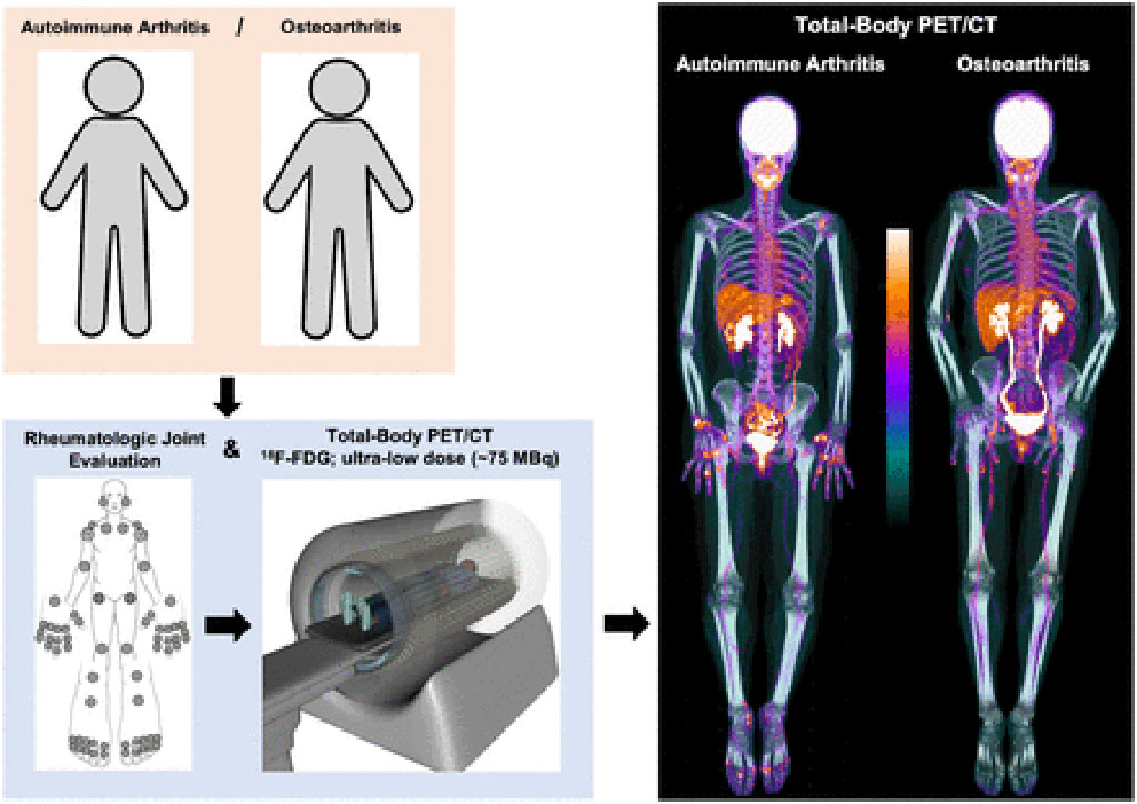 Image: Systemic joint evaluation in AIA (and non-AIA) is feasible with TB PET/CT system and ultra-low-dose protocol (Photo courtesy of University of California–Davis) Image: Systemic joint evaluation in AIA (and non-AIA) is feasible with TB PET/CT system and ultra-low-dose protocol (Photo courtesy of University of California–Davis)