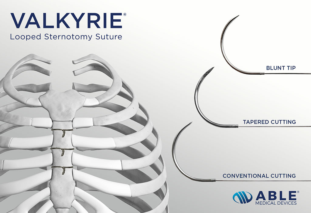 Image: Valkyrie Looped Suture doubles the surface area of single wires and provides a more robust sternal closure (Photo courtesy of Able Medical Devices)