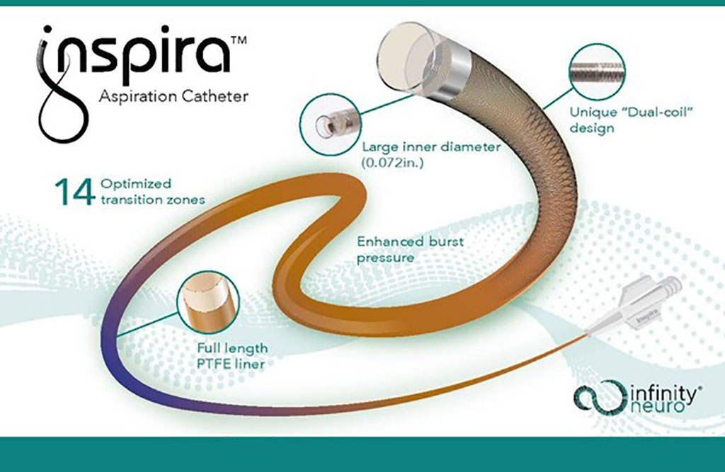 Image: The Inspira aspiration catheter has received CE Mark approval (Photo courtesy of Infinity Neuro)
