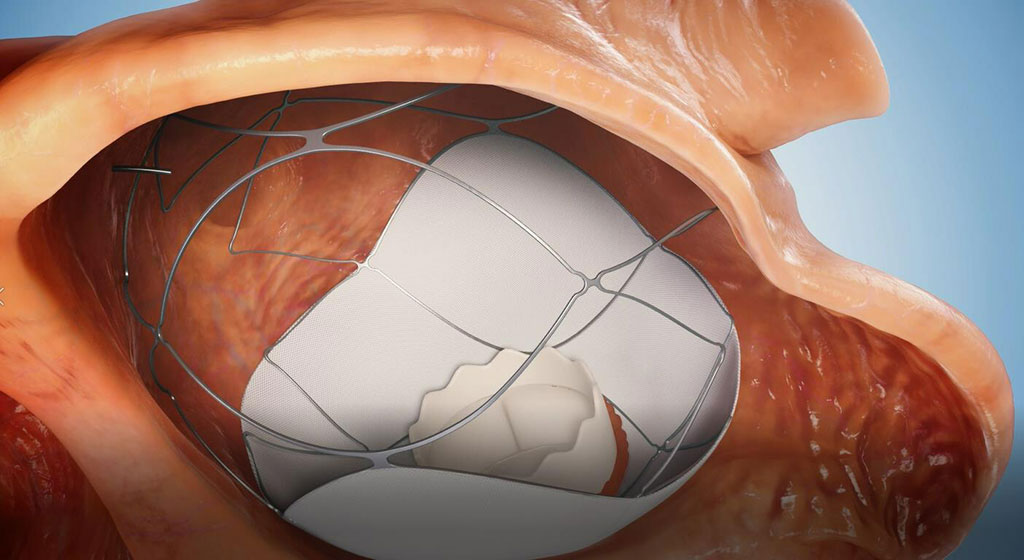 Image: The innovative RoseDoc platform replaces the patient\'s leaky heart valve (Photo courtesy of TruLeaf Medical)