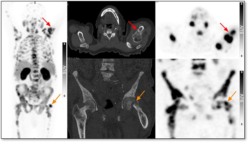 Image: 68Ga-PSMA-11 PET/CT of 82-year-old male patient with bone pain and PSA levels of 960 ng/ml (Photo courtesy of Tel Aviv Sourasky Medical Center) Image: 68Ga-PSMA-11 PET/CT of 82-year-old male patient with bone pain and PSA levels of 960 ng/ml (Photo courtesy of Tel Aviv Sourasky Medical Center)