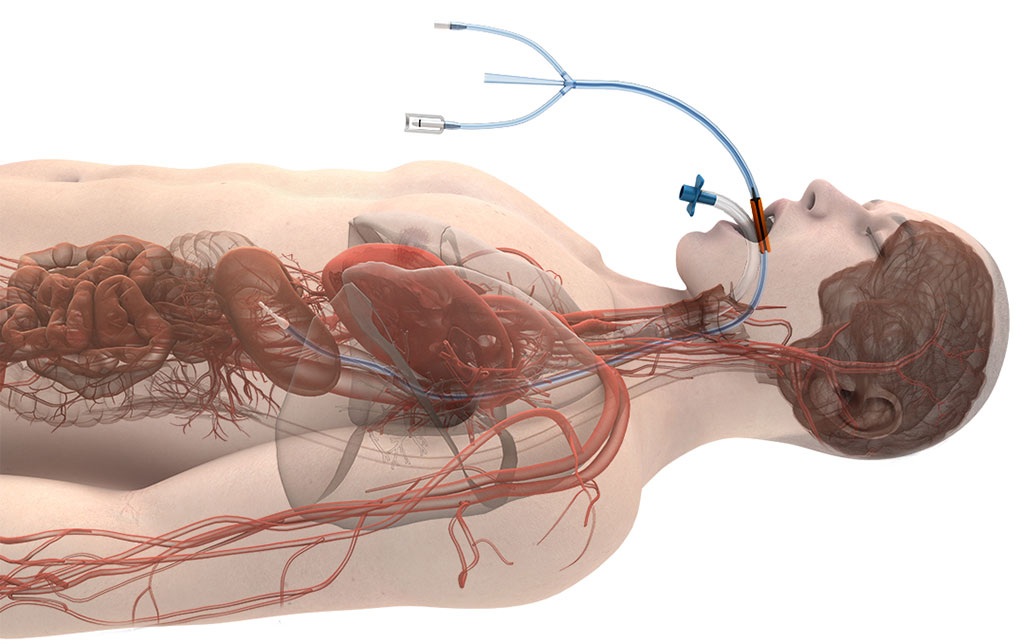 Image: The ensoETM device has been granted FDA De Novo marketing authorization (Photo courtesy of Attune Medical)