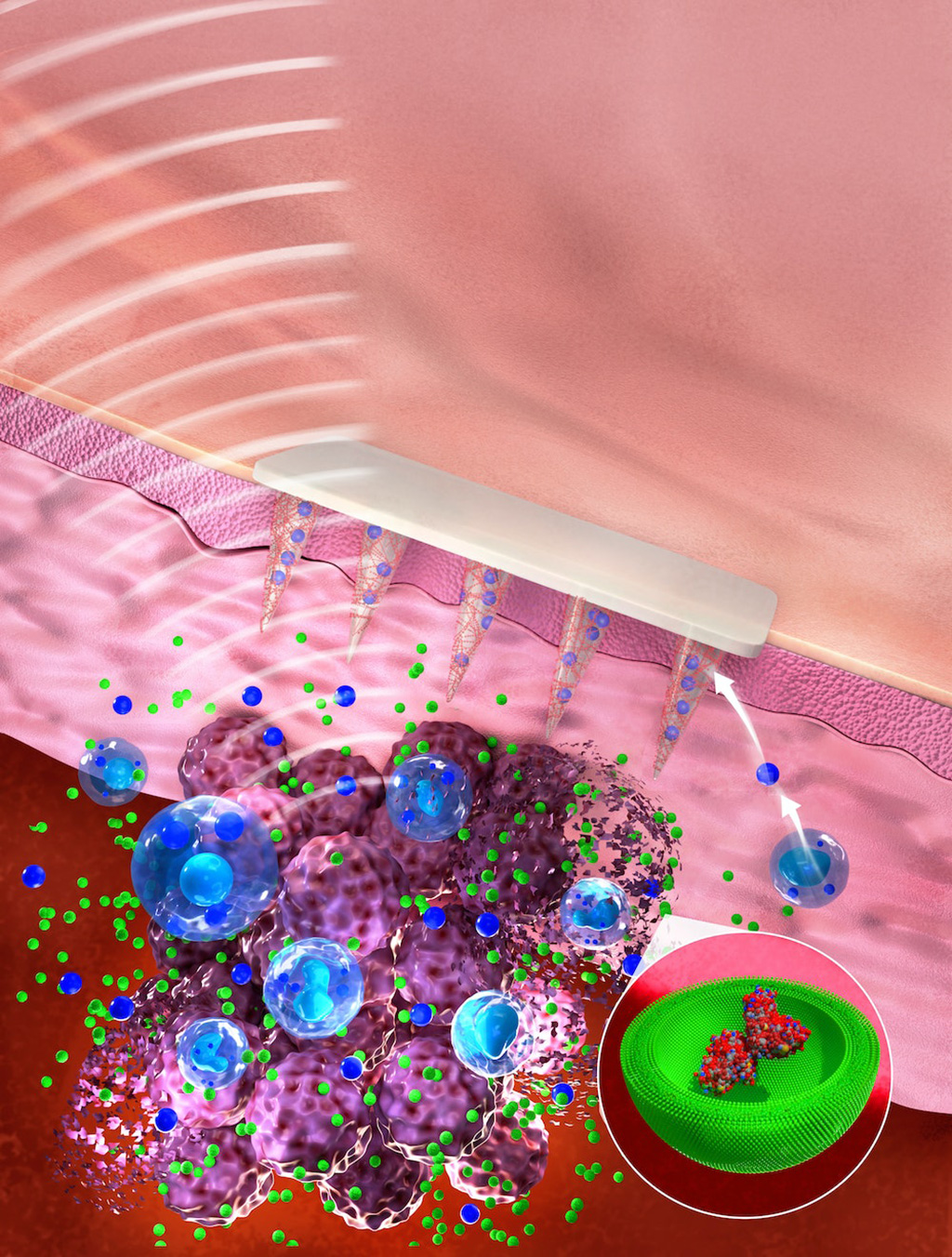 Image: Biomarker molecules can be sampled from melanoma lesions using microneedles (Photo courtesy of Wyss Institute)